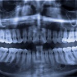 Sind Zahnimplantate wirklich ungefährlich? Sind Zahnimplantate wirklich ungefährlich?